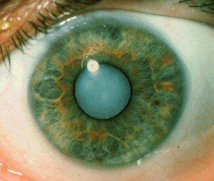 Cataratas operacion, catarata ojo, catarata cristalino