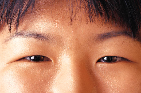 cirugia refractiva china, ojos de chino