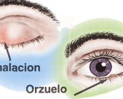 Chalazion orzuelo