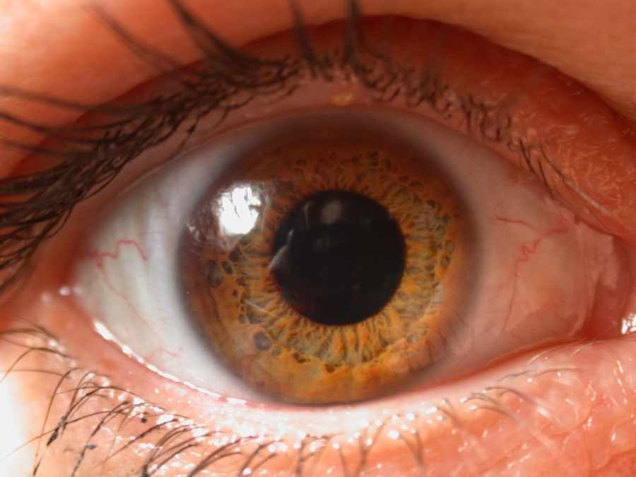 cornea artificial